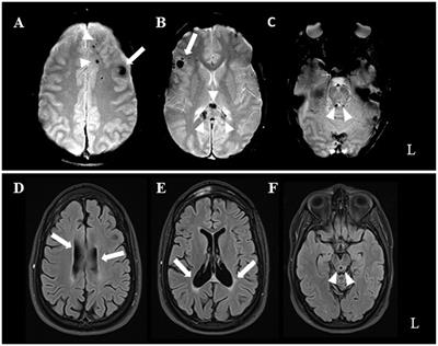 Efficacy of transcranial magnetic stimulation treatment in reducing neuropsychiatric symptomatology after traumatic brain injury